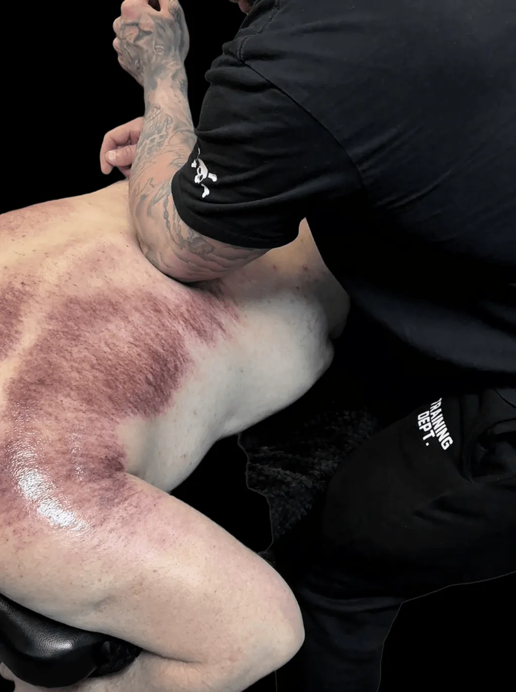 Close-up of IASTM muscle scraping treatment on a client's back