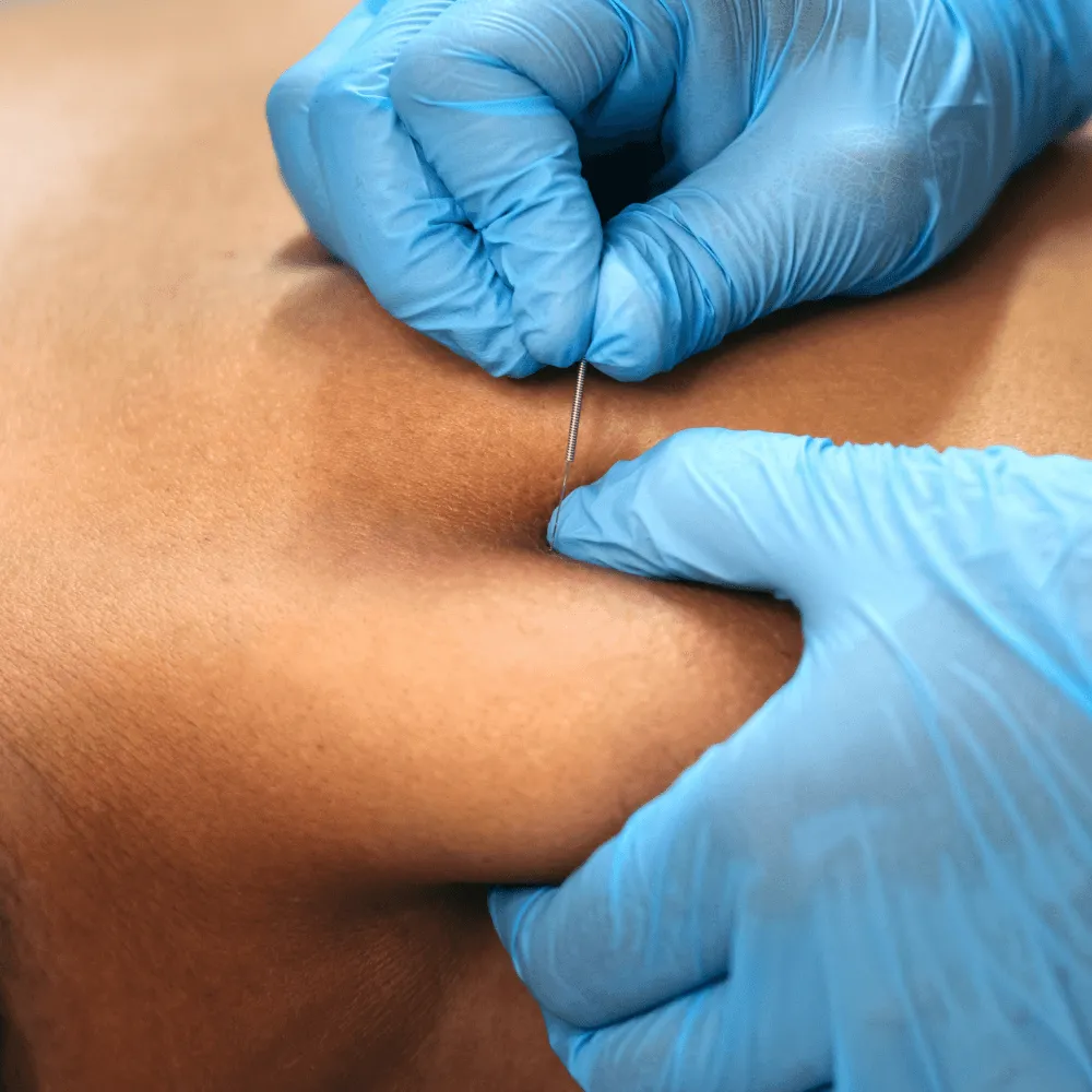 Multi-Dry Needling