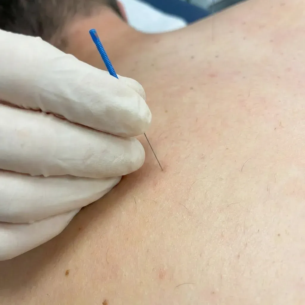 Multi-Dry Needling in Warrington